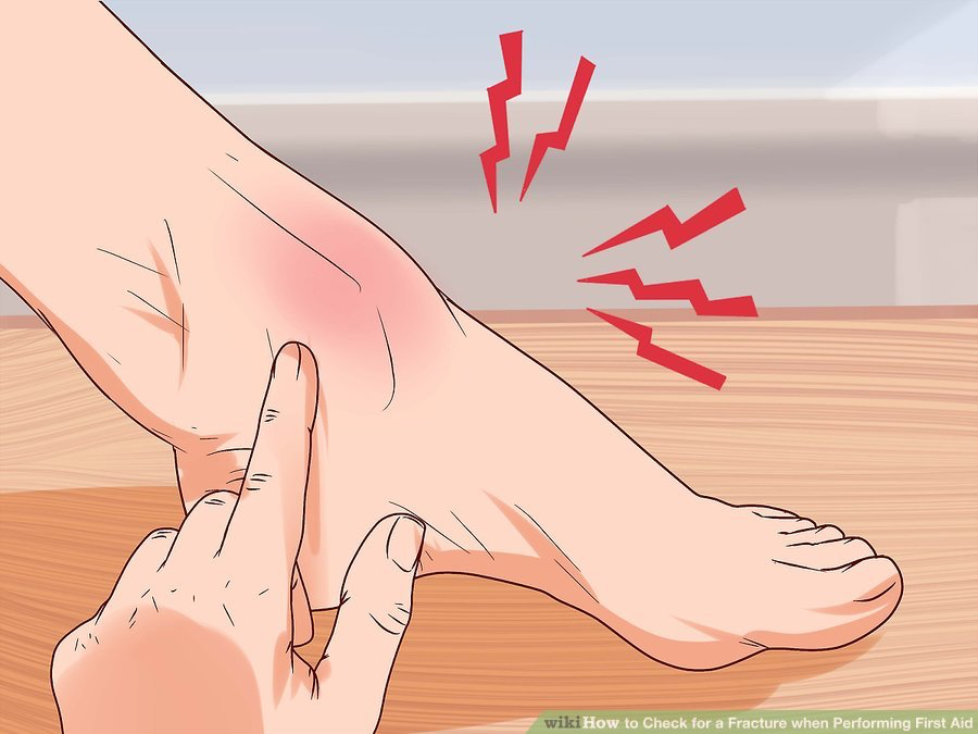 How to Check For a Fracture when Performing First Aid